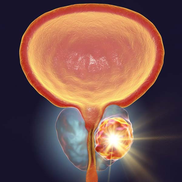 Focal Therapy